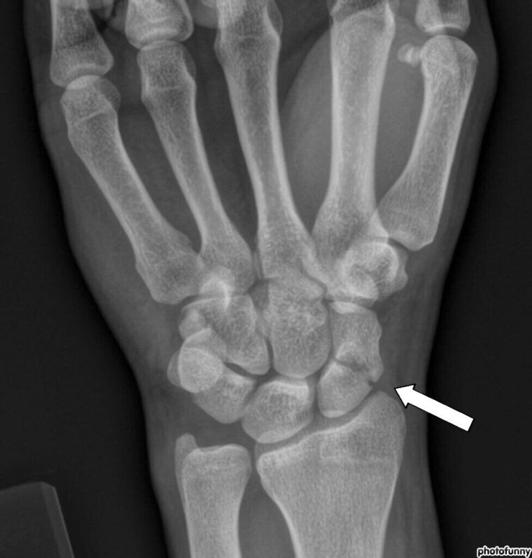 displaced fracture