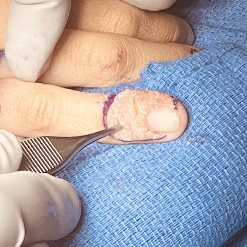 Surgeon performing surgery on a man's finger